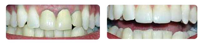 Older metal crowns show grey at the gum line. New material shows a seamless transition between gum and tooth!