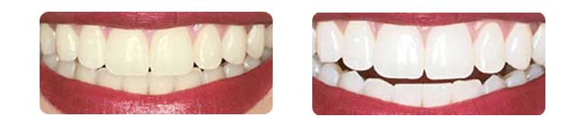 before-and-after-whitening