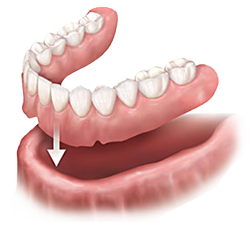 complete-dentures