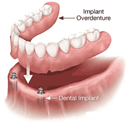 implant-supported-overdenture