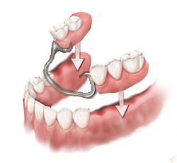 partial-dentures