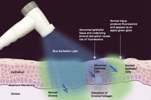 oral cancer screenings