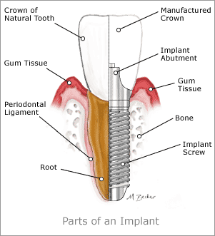 dental-implants-naples-fl"