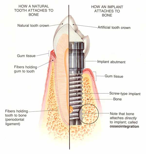 osseointegration_600x635